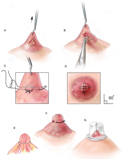 Invaginated-nipples-surgery-Tunisia